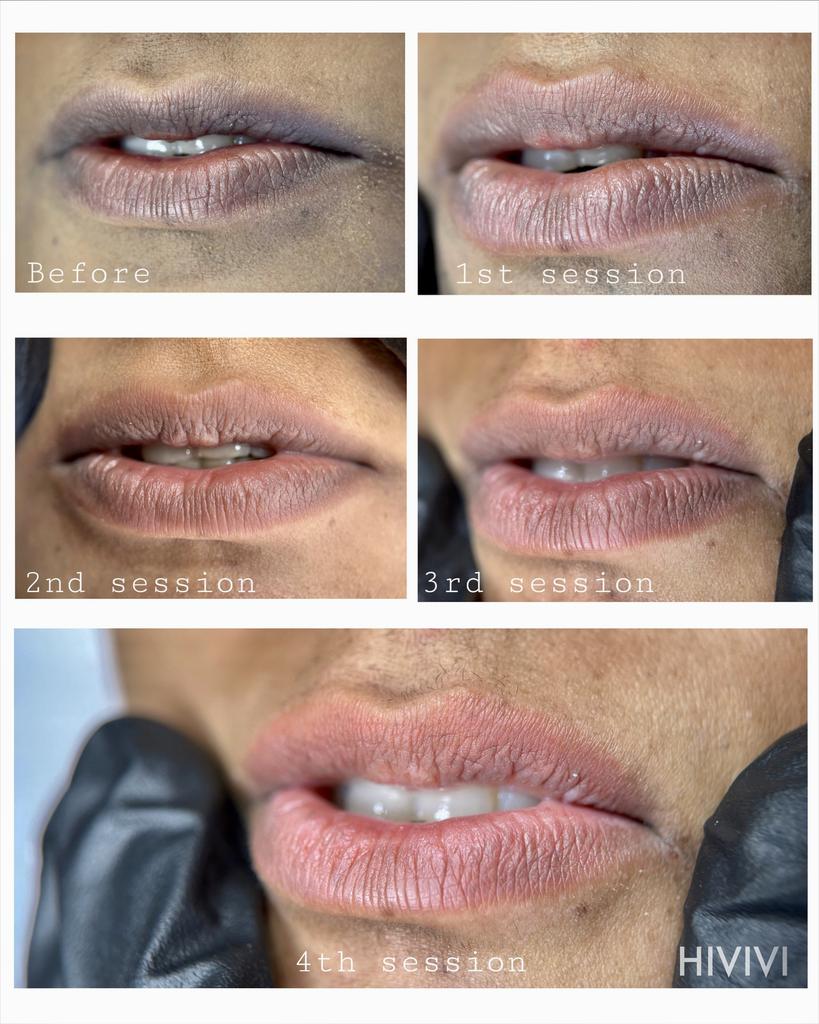 Lip Neutralization 101: Your Ultimate Guide to Brighter, Beautiful Lips in Auckland